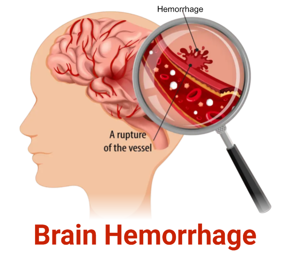 Brain Hemorrhage
