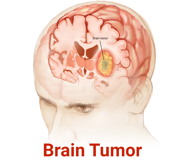 Brain Tumor