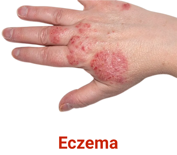Eczema