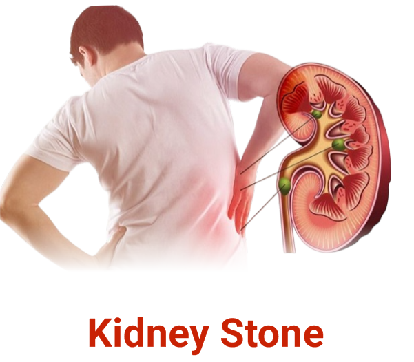 Kidney Stone