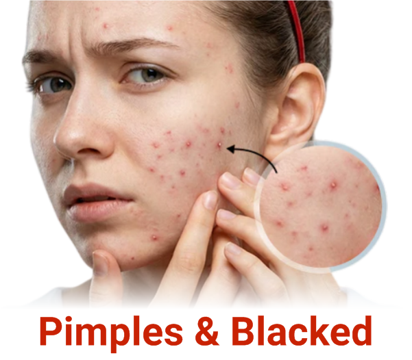 Pimples & Blacked