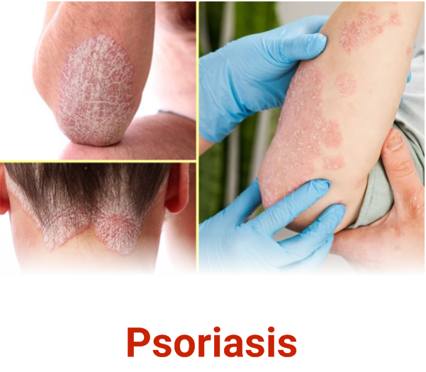 Psoriasis
