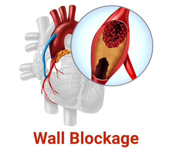 Wall Blockage
