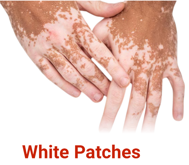 White Patches